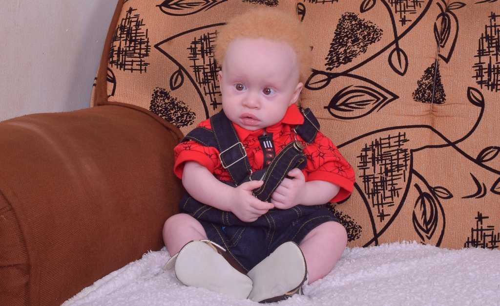 Miklah for albinism