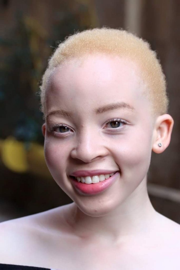 summary on albinism