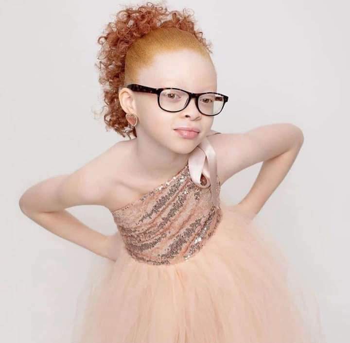 albinism causes