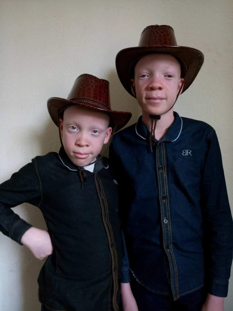 How common is albinism