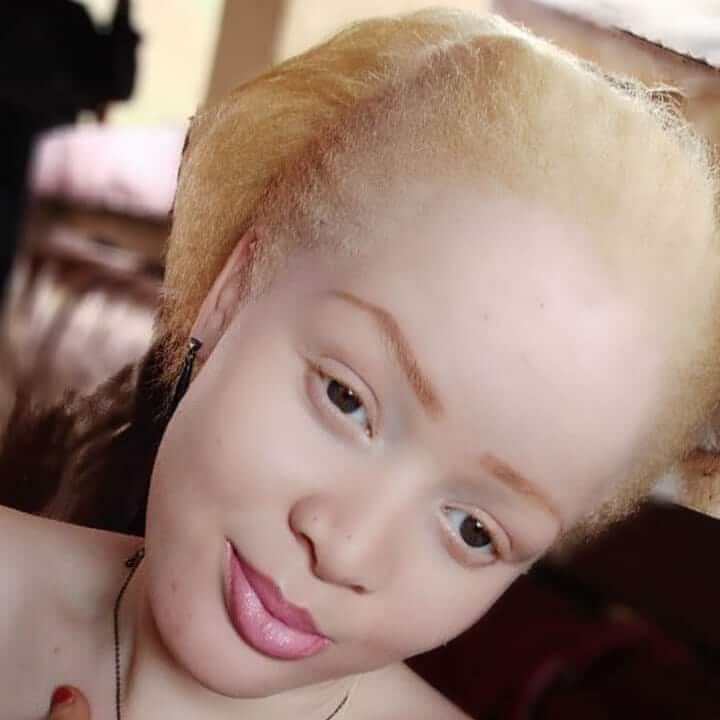 What is albinism