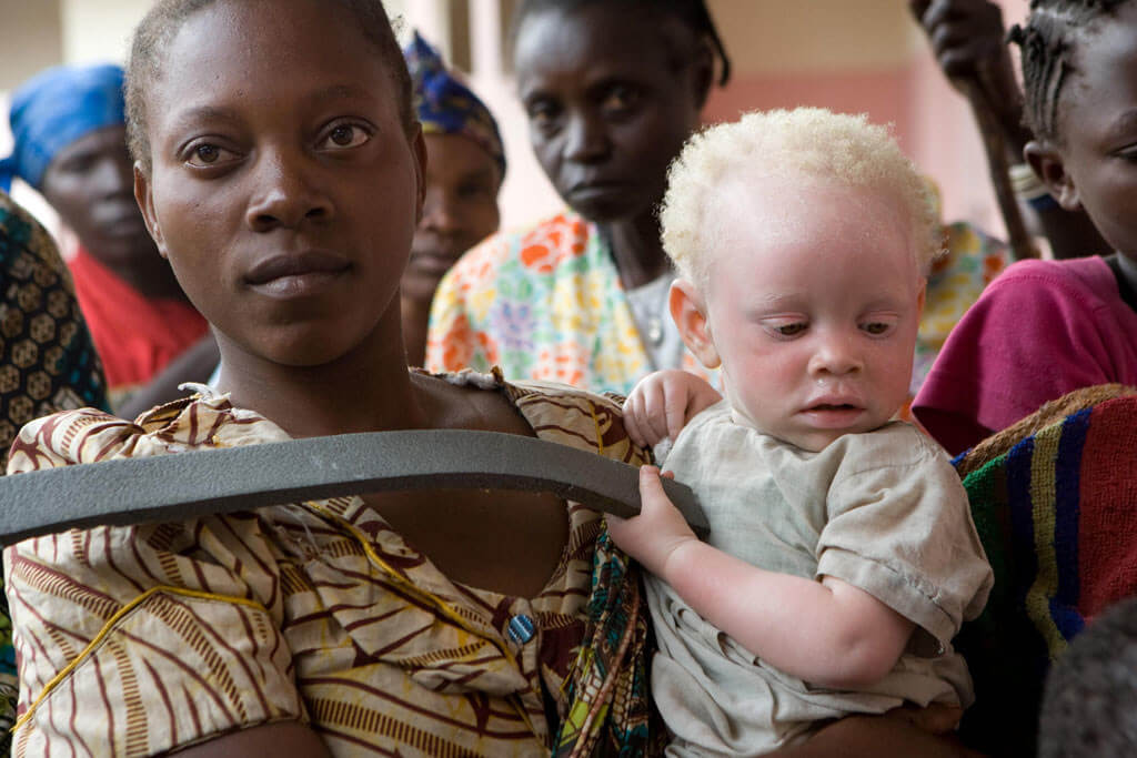 Building Resilient Self-Esteem for Children With Albinism: A Parent’s Guide!